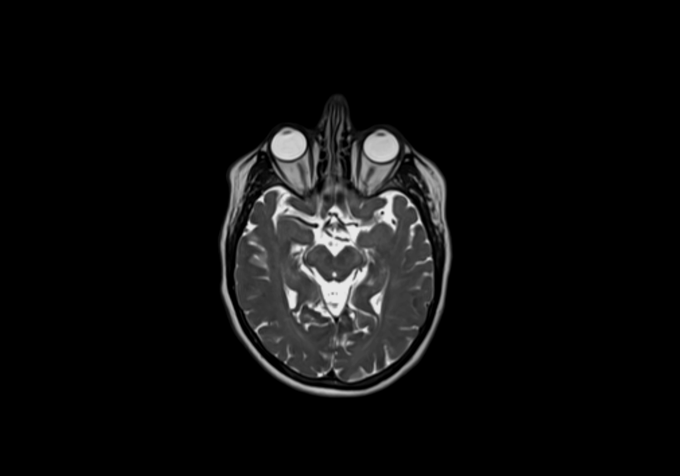 Neck axial  lymph node cross sectional MRI anatomy 3T MRI  image-img-00001-00002.webp